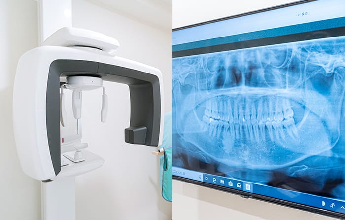 デジタルレントゲンの写真
