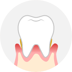 中度歯周病のイラストイメージ