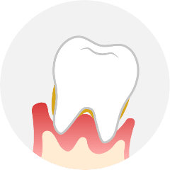 重度歯周病のイラストイメージ