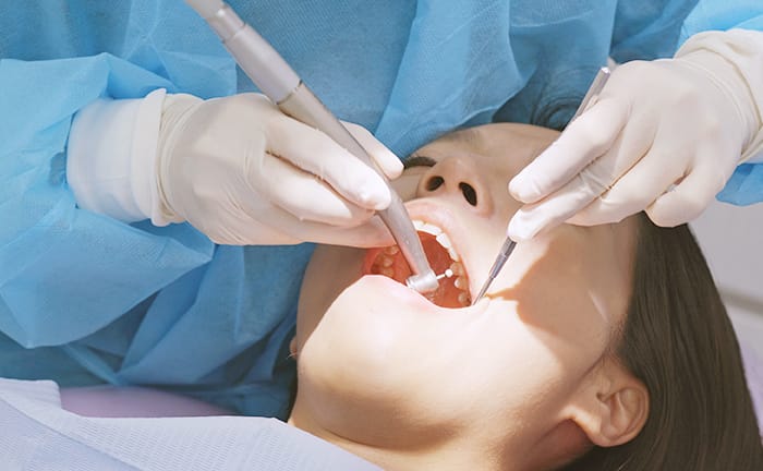 歯石除去（スケーリング）の写真