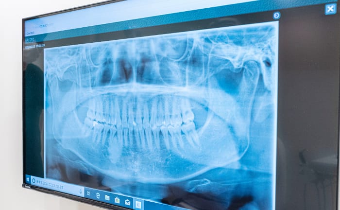 歯のレントゲン写真