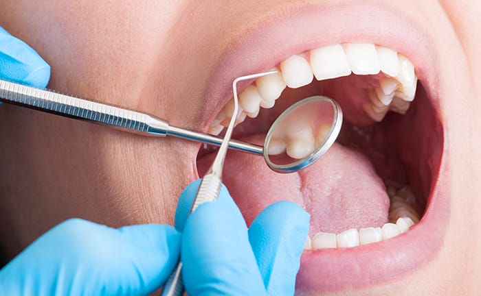 歯垢・歯石除去の写真